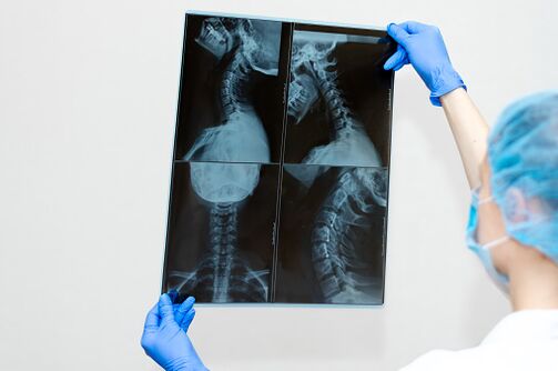 Osteochondrosis onemocnění páteře