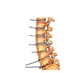 stádia vývoje osteochondrózy