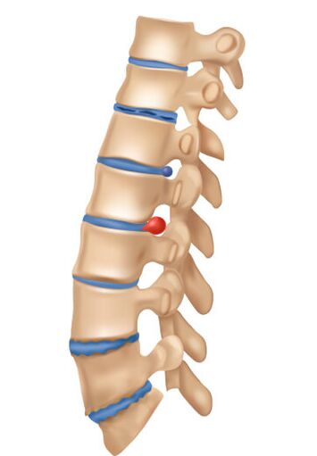 Jak vypadá deophromingová osteochondrosis
