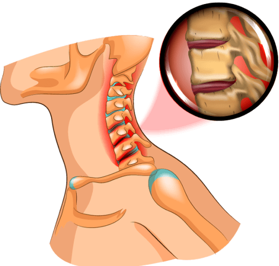 osteochondrosis v krku